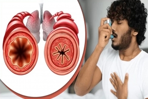 শীতে অ্যাজমা ও শ্বাসকষ্ট থেকে মুক্তি পেতে করনীয়