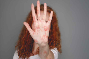 হাম কি ছোঁয়াচে রোগ?